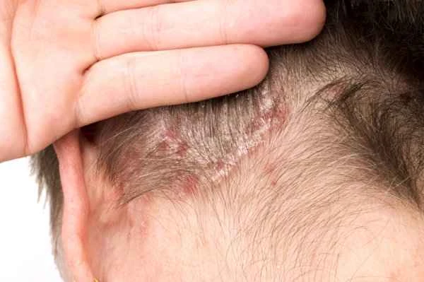 Is chronic urticaria contagious?