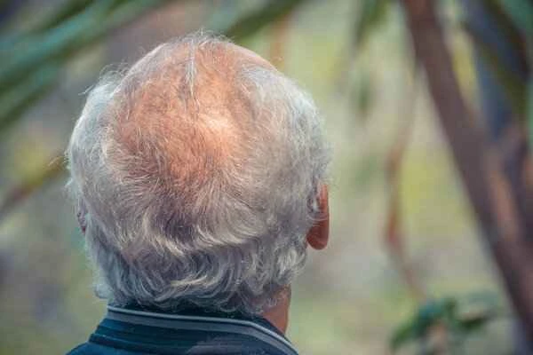 Is gray hair caused by folic acid deficiency?