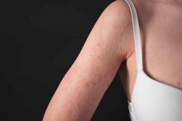 How to diagnose atopic dermatitis?