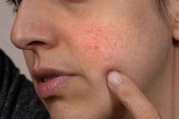 Is seborrheic dermatitis a type of chronic dermatitis?