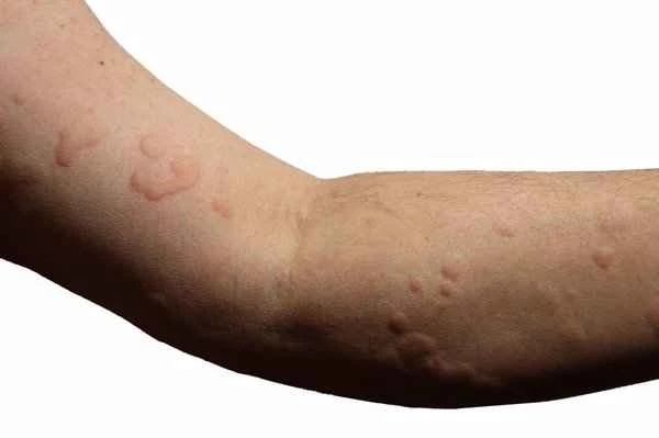 Is chronic urticaria contagious?