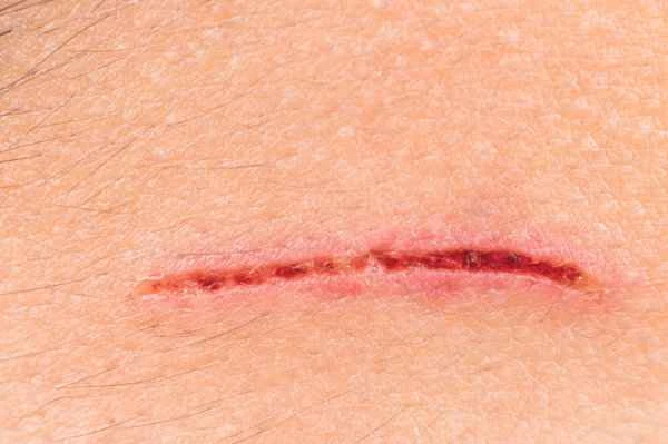 How is scar repair performed?