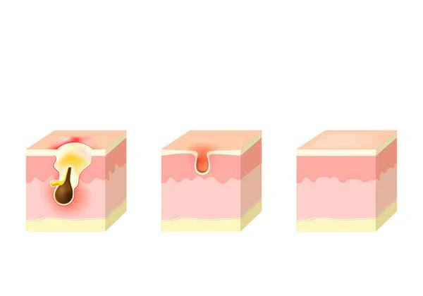 How to treat pitted scars