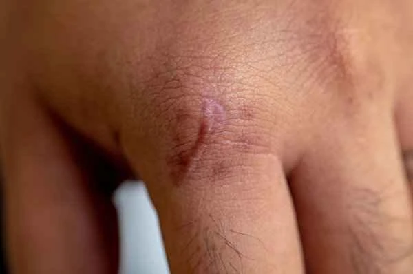 How to understand the area of ​​scars all over the body