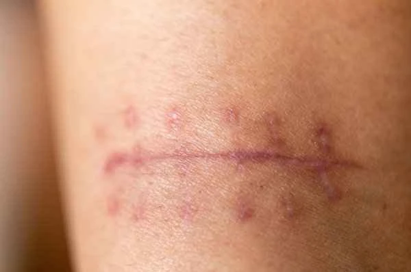 How to repair depressed scars that have flattened out