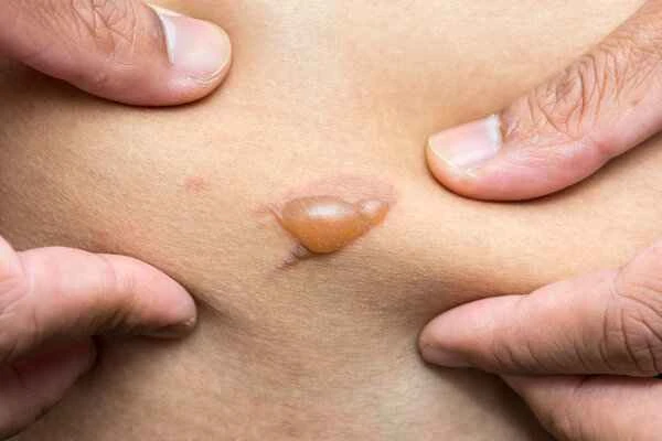 How to check if you have a tendency to form keloids?