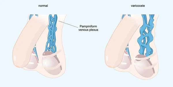 Does scrotal inflammation cause pain in the scrotum?