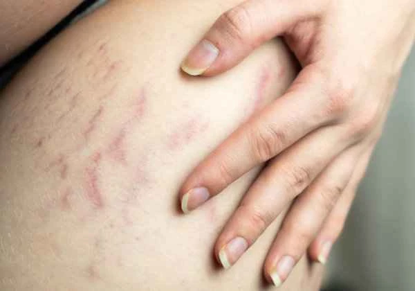 What causes a person's skin to resemble snakeskin?