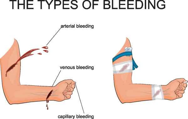 What to do about bleeding from internal incision scars?