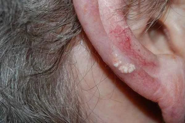 How to treat keloid scars on the auricle