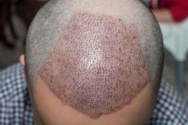Folliculitis after hair transplant