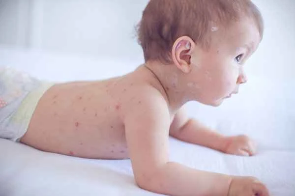 How to treat shingles combined with insomnia?