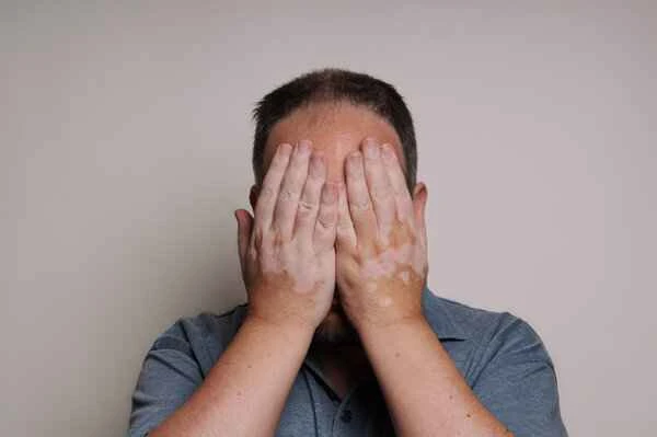 Is there any way to control vitiligo?