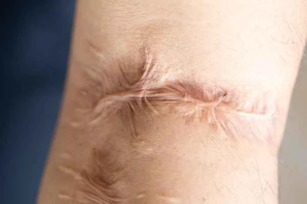 How to rehabilitate scar adhesions?