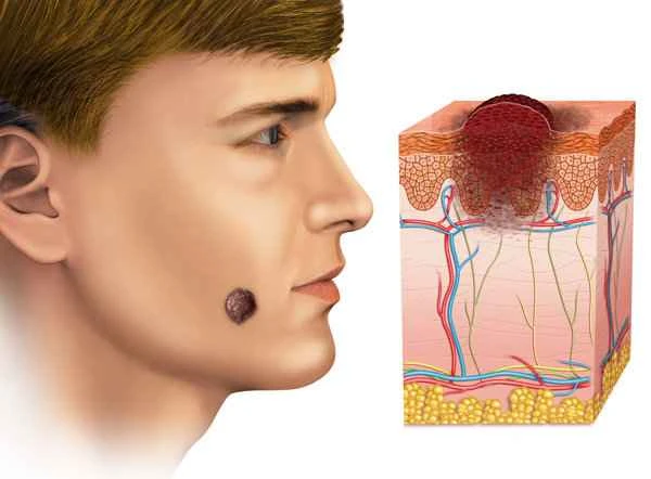 How to prevent facial scar hyperplasia