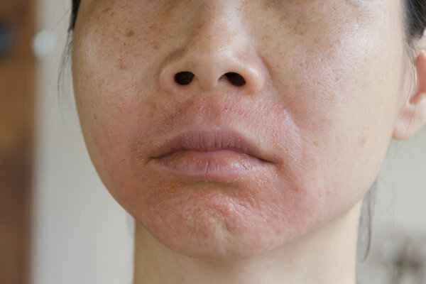 How to treat cheilitis and facial allergies?