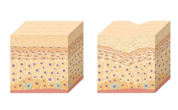 How to remove residual skin scars