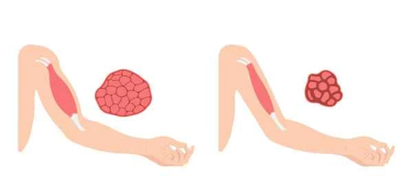 How to remove internal muscle scars