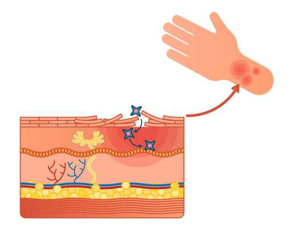 How can keloid scarring be cured?