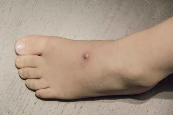 What are warts on the feet called?
