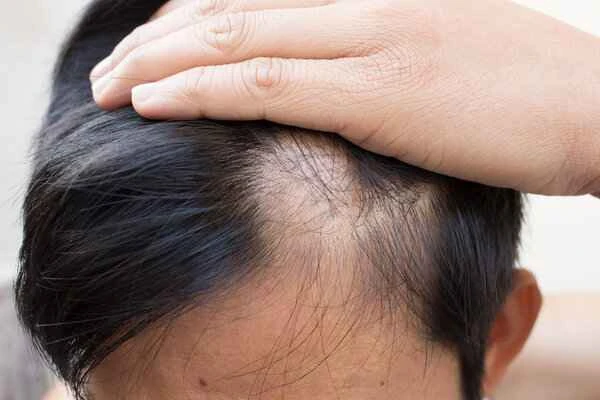 Is hair loss on the top of the head alopecia areata?