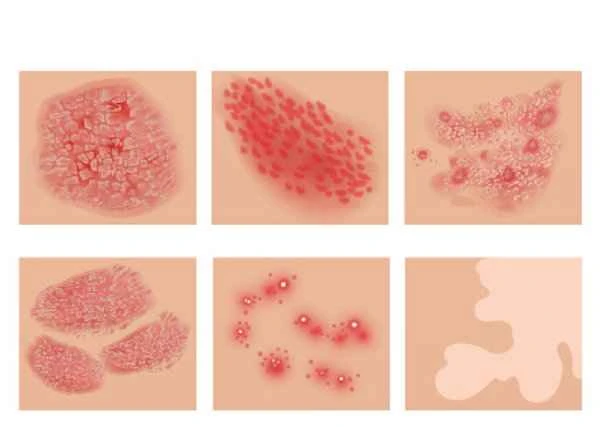 Will the shingles virus recur?