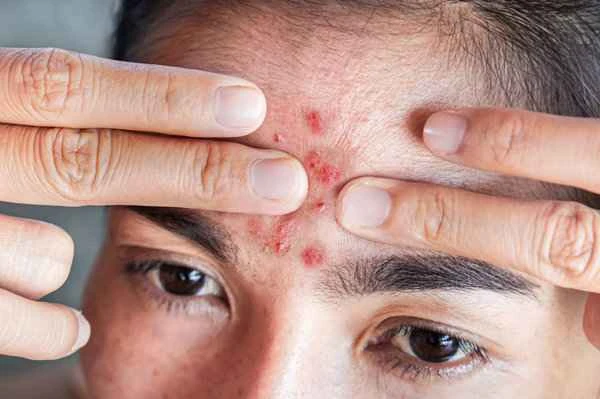 What to do about red scars left by acne?