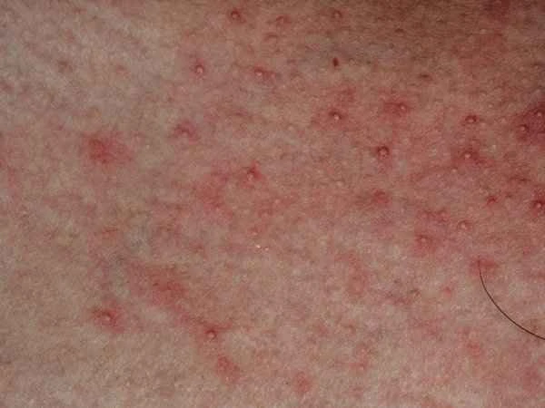 How can folliculitis heal quickly?