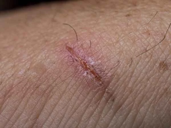 Can Bactroban soften scars?