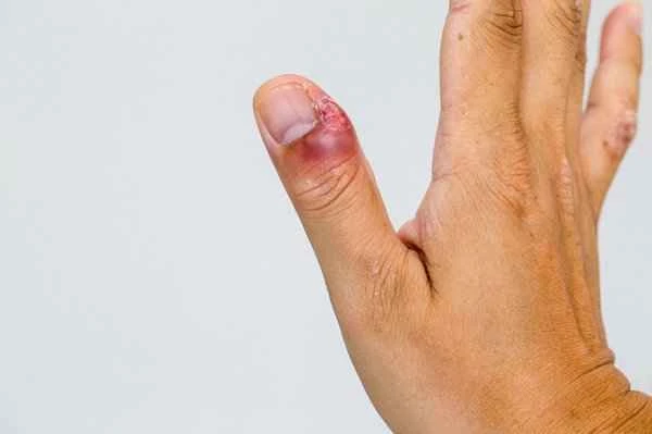 What to do if my fingernail paronychia is infected and suppurating?