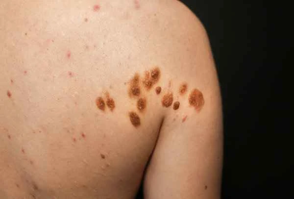 Will keloids that turn black grow back?