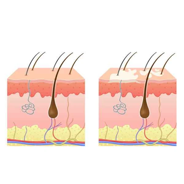 How to remove keloid scars?