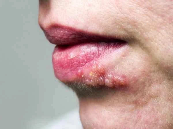 What to do about red, swollen, and itchy edges of cheilitis?
