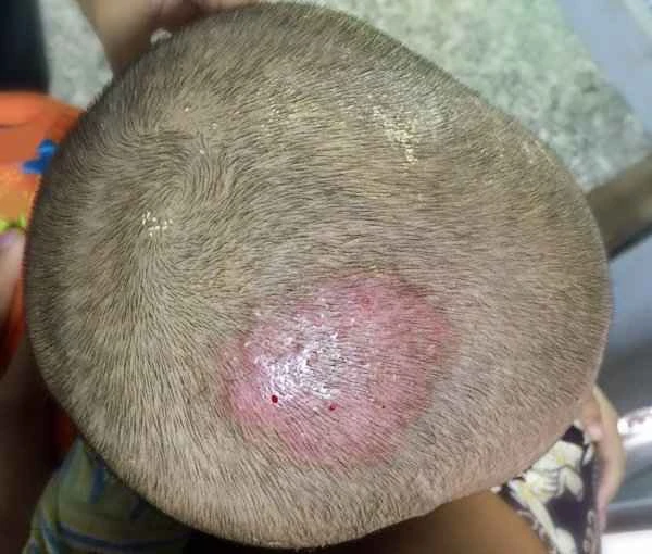 How to treat scalp incision scars
