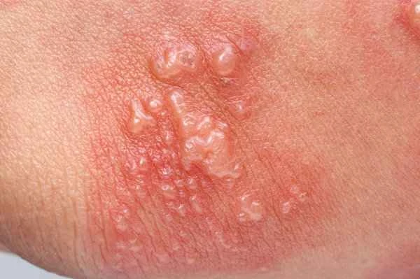 What are the causes of shingles rash?