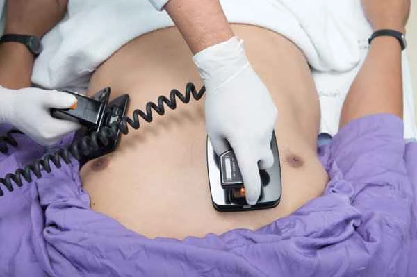 How long does it take for keloids to form?