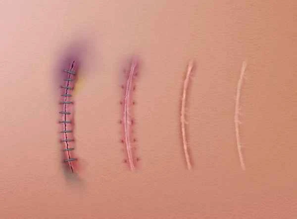 How to remove keloids? Are they contagious?