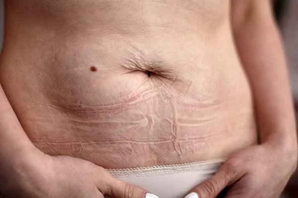 What happens if a tattoo is used to cover a scar on the chest?