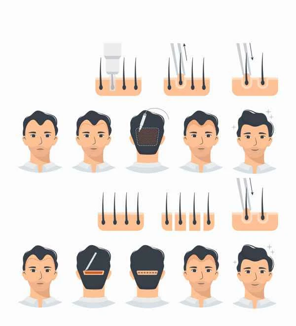 How to treat scalp incision scars