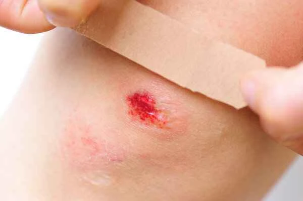 How is a predisposition to keloid scarring determined?