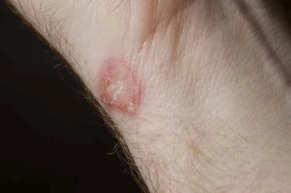 How long does it take for heparin sodium to take effect in scar treatment?