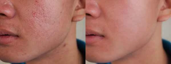 Keloids appear after skin lesion repair