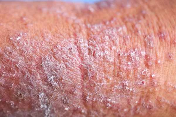 Is seborrheic dermatitis a type of chronic dermatitis?