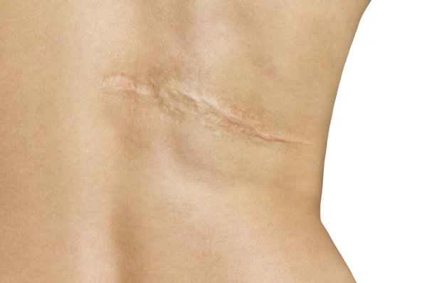 How to prevent scarring in people with keloid-prone skin?