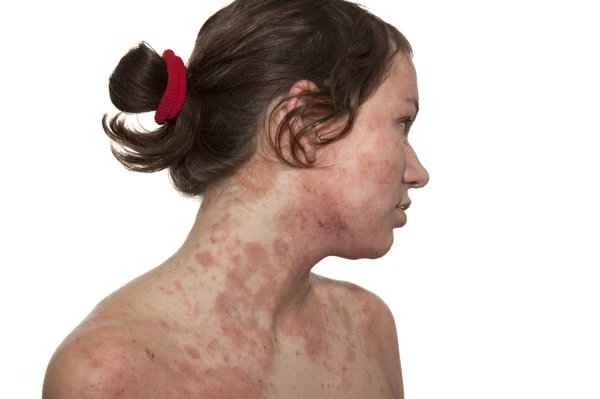How to diagnose atopic dermatitis?
