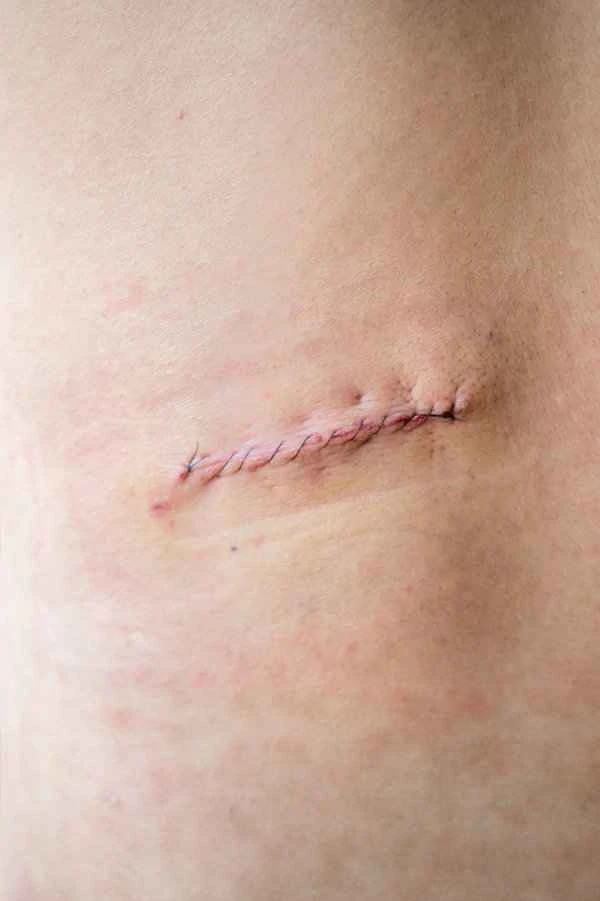How to distinguish between scars and herpes?