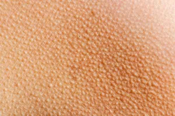 What causes a person's skin to resemble snakeskin?