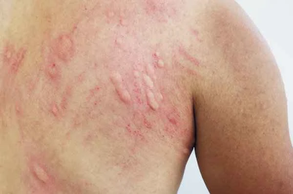 Scrotal eczema is an allergic skin disease.