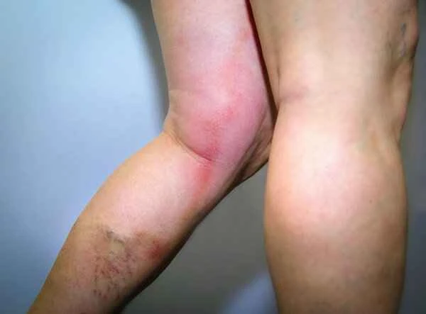 What disease causes symmetrical rashes on both lower limbs?