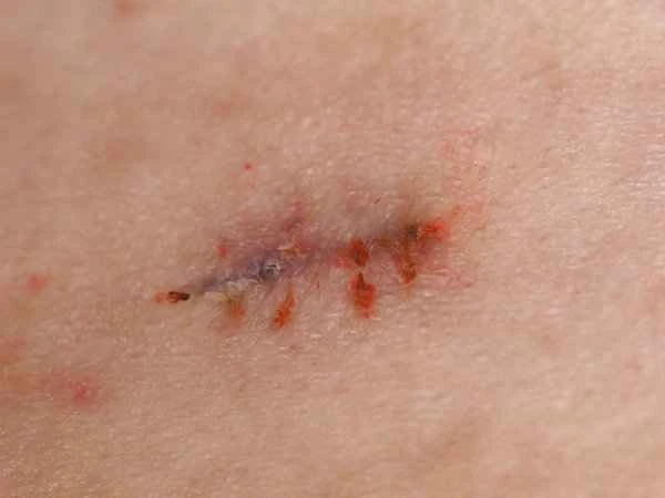 How long does it take for the scabs to fall off after temporary tattoos cover scars?